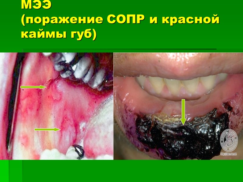 МЭЭ (поражение СОПР и красной каймы губ)